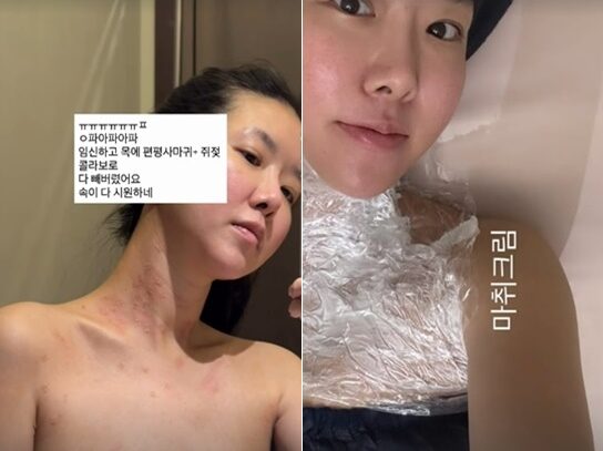“목에 마취크림 한가득” 김지혜, 임신하고 피부 달라졌다는데…왜?
